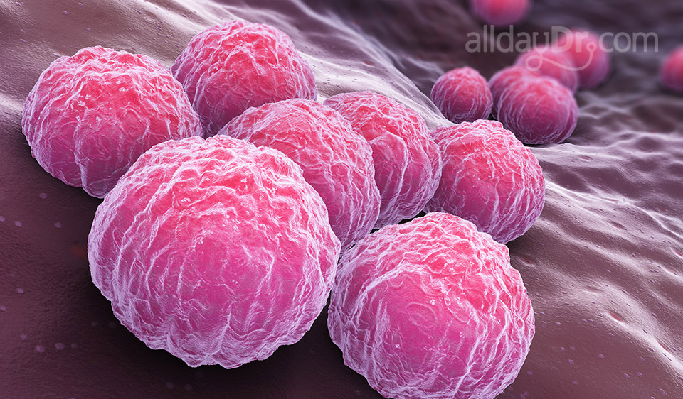 Chlamydia Chlamydia