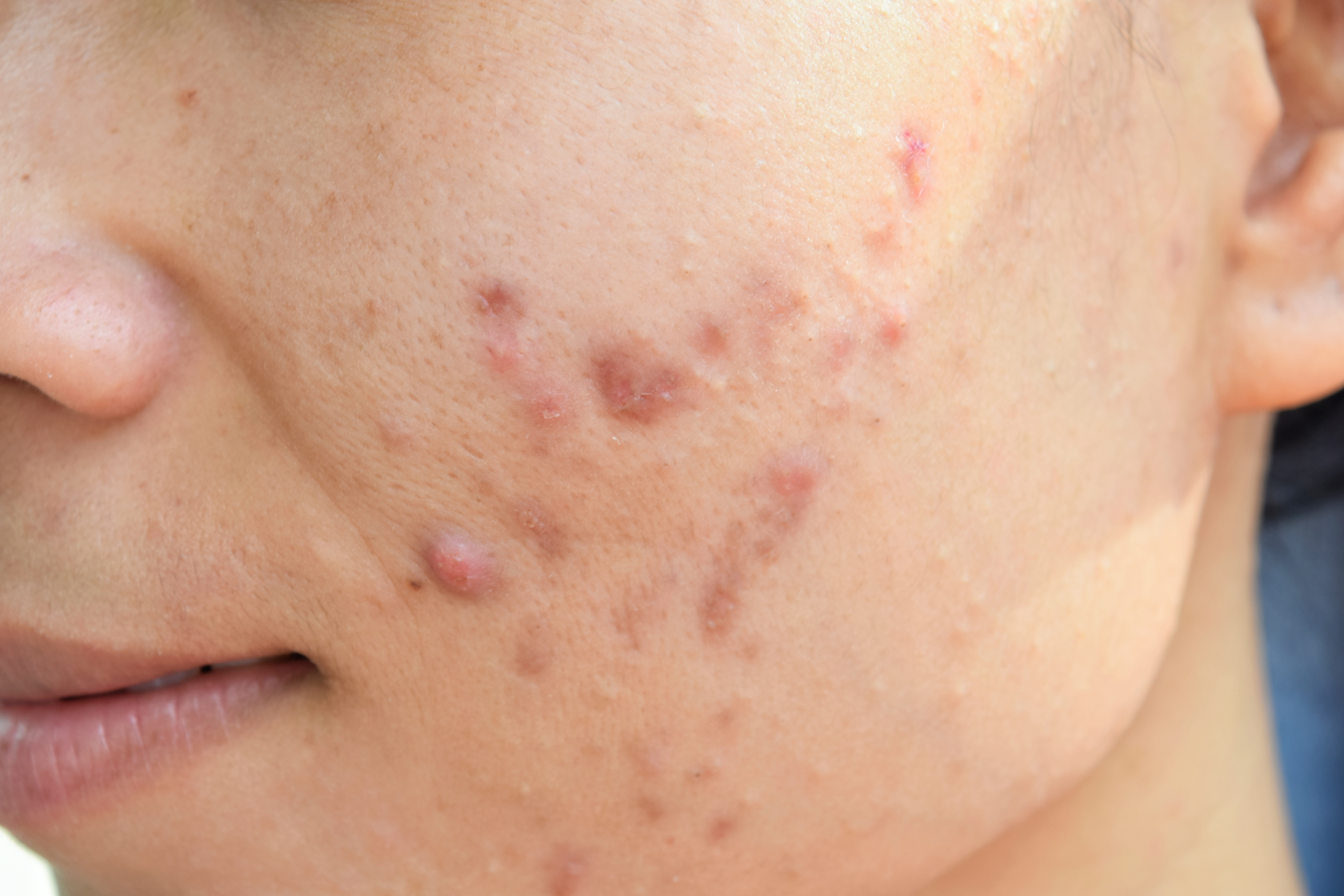 Acne Rosacea Acne Rosacea