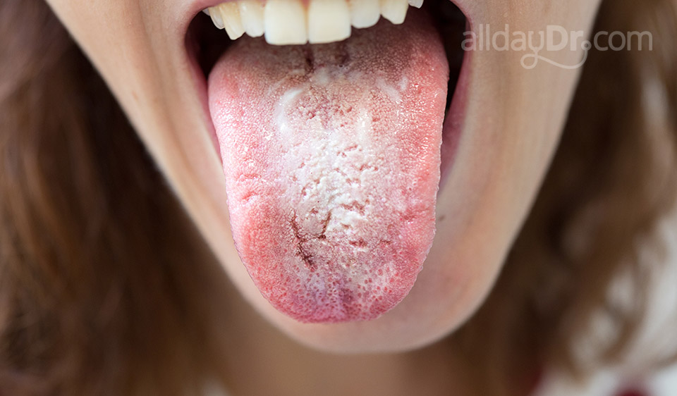 Oral Thrush Oral Thrush