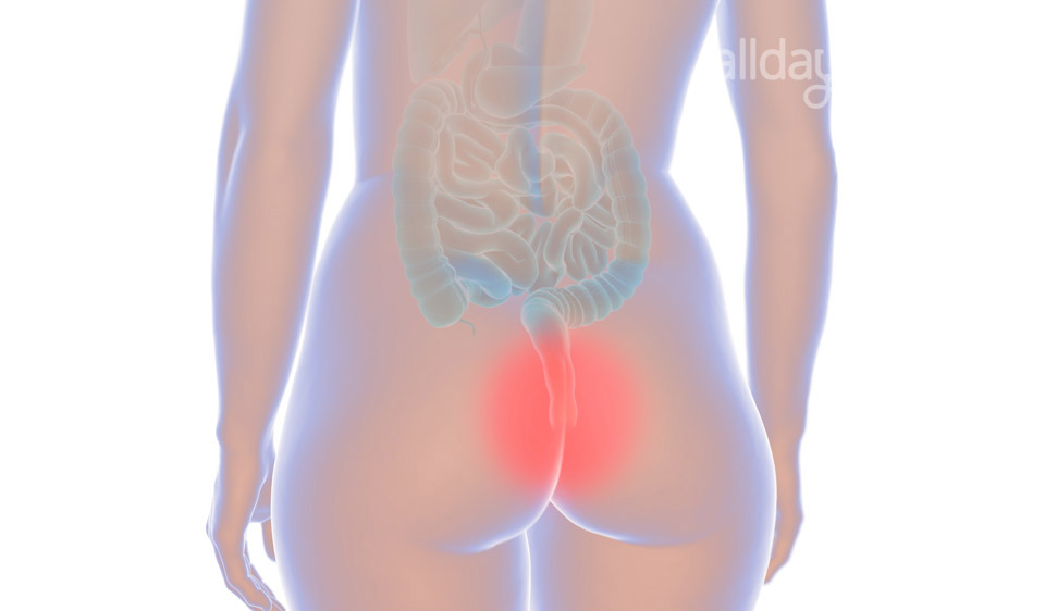 Anal Fissure Anal Fissure