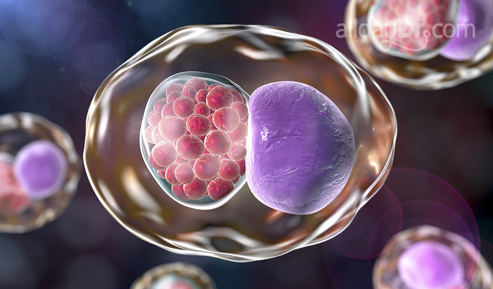 Bacterial Vaginosis Bacterial Vaginosis